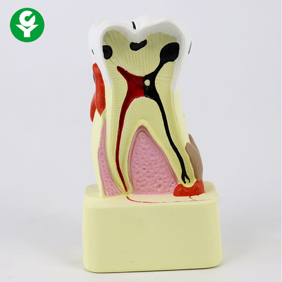 Modello dentario dei denti di confronto della carie/modelli dimostrativi dentari per insegnare